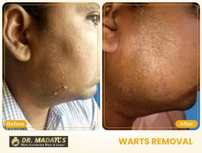 Warts removal before and after result 8 at Dr Madan Aesthetics